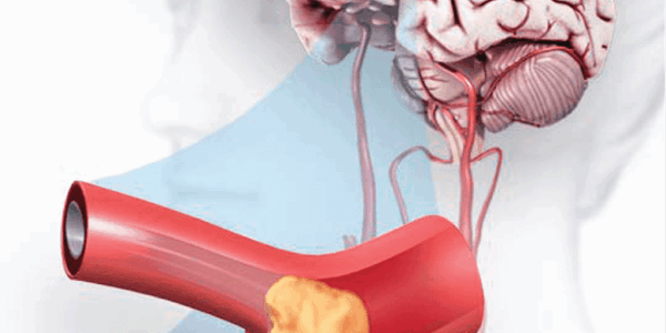 Why Risk of Strokes Are Higher in Women Than in Men